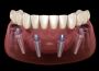 Understanding Full Mouth Rehabilitation in Dubai