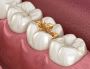 Caring & Experienced Dentist in Merrylands | Krown Dental