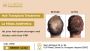Hair PRP treatment in Gurgaon: La Midas Aesthetics