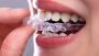 Cosmetic Dentistry Treatments in Bethlehem | Teeth Whitening