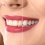 Dental Crowns in Bethlehem | Dental Care Bethlehem