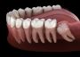 Impacted Wisdom Teeth Removal Near Me