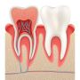 Root Canal Treatment