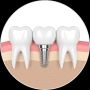 Affordable Dental Implants Cost in Mississippi