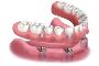 Costing of Dental Implants in Gulfport, MS