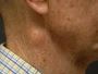 How to Remove Lipomas Naturally Without Surgery? How to Remove Lipomas Naturally Without Surgery?