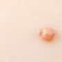 Expert Genital Wart Removal at London Dermatology Clinics – 