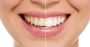 Get the Best Teeth Whitening in Campbell for a Brighter