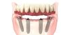 Restore Your Smile with Dental Implants in Campbell