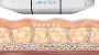 Non-surgical neck and face lift - Ultherapy