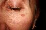 5 Causes of Skin Pigmentation Problems