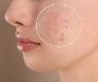 5 Effective acne scar treatment in Singapore