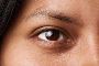 Exploring Professional Treatments for Dark Circles