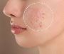 5 Tips for Maximizing Results from Laser Treatment for Scars