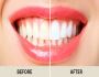 Achieve Your Dream Smile – Best Cosmetic Dentistry in NYC