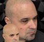 Scalp Micro Pigmentation Treatment
