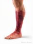 cellulitis