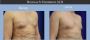 Discreet Male Breast Reduction Los Angeles Services