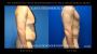 Loose Skin Surgery New York for Post-Weight Loss Body Contou