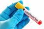 Lipid Profile Blood Test Lipid Profile Blood Test