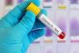 Vitamin D25 Hydroxy Test