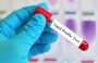 Lipid Profile Test