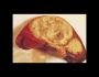 Liver Abscess Treatment in Pune