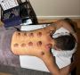 Dry Cupping Therapy 