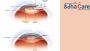 Cataract Surgery Cost In India | EdhaCare