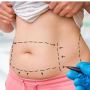 Tummy Tuck Procedure at Maryland Specialty Group: Achieve Yo