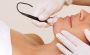 Electrolysis Hair Removal Side Effects in Chennai 