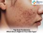 Struggling with Acne? We’ve Got the Right Treatment