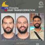 FUE hair transplant in India
