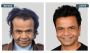 FUE Hair Transplant Cost In India