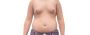 Understanding Puberty-Onset Gynecomastia Surgery in Delhi