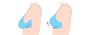 Breast Lift vs. Implants: Which Procedure is Right for Me?