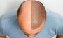 Which is the Best Hair Transplant Clinic in India?