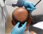 Best Hair Transplant in Delhi  by Dr. Lokesh Handa