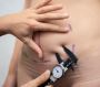 Tummy Tuck Surgery in Delhi by Dr. Lokesh Handa