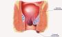 Say Goodbye to Hemorrhoids – Trusted Treatment in Dubai