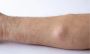 Lipoma Removal Without Scars – Expert Treatment in Dubai
