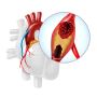 CABG Surgery in India with Expert Heart Specialists and Low 