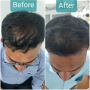 Best Hair Transplant Clinic in Jaipur