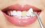 Dental Veneers - Transform Your Smile Today!