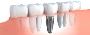 Canada's Most Trusted Dental Implant Clinic - Why Patients C