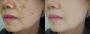 Expert Pigmentation Removal in Singapore by Mirage Aesthetic
