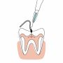 Save Your Natural Tooth with Expert Root Canal Retreatment!