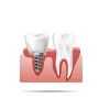 Dental Implant Clinic Kolkata for Quality Tooth Replacement