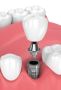 Affordable Dental Implants in Morayfield