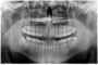 Clear, Precise, and Fast OPG X-Ray at MS Medical Care !